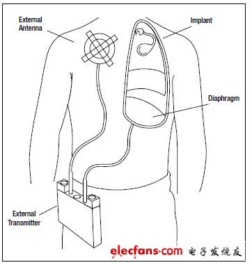 圖7,呼吸起搏器帶有用于膈神經(jīng)刺激的植入電極以及RF接收器，還有向植入體發(fā)射RF信號(hào)的外部天線，完成刺激起搏功能